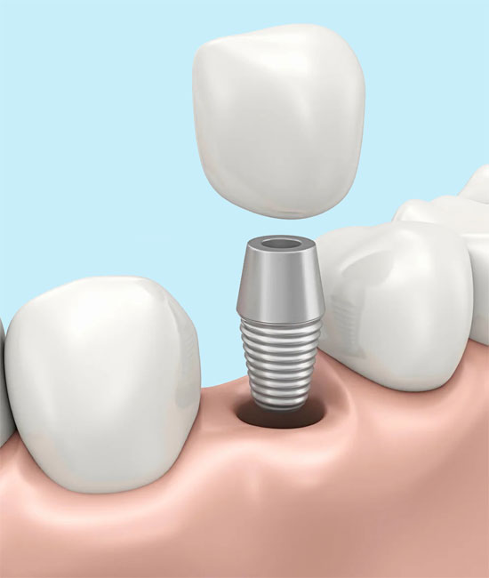 Зубной имплант в Турции